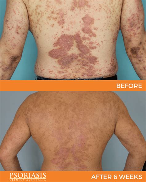 Psoriasis Specialist Gallery Psoriasis Clinics Australia