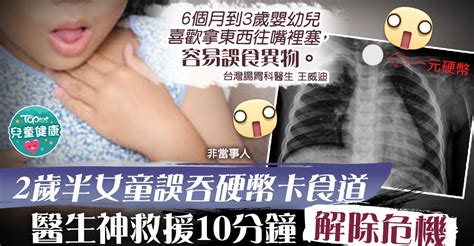 【家居意外】台2歲半女童誤吞硬幣卡食道 醫生神救援不用麻醉10分鐘解除危機 香港經濟日報 Topick 親子 兒童健康 D201209