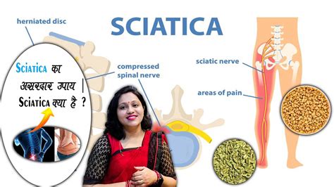 Sciatica Ka Asardar Upaay Kya Gharelu Upaay Se Thik Ho Shakti Hai