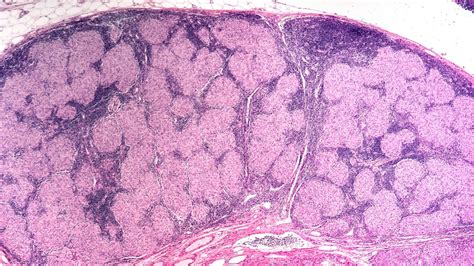 Sarcoidosis Of The Skin Cutaneous Sarcoidosis — Foundation For