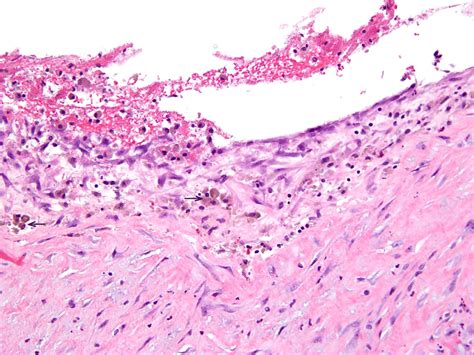 An Atypical Presentation Of Extraovarian Endometrioma