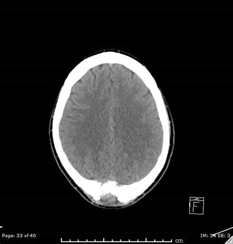 Skull Vault Hemangioma Image Radiopaedia Org