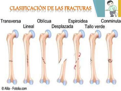 Generalidades De Fracturas