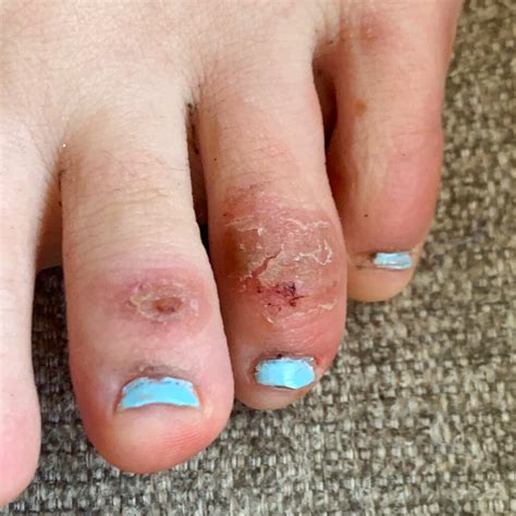 Covid Toes Other Rashes Latest Possible Rare Coronavirus Signs