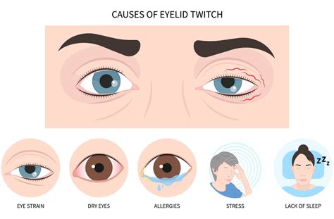 Eye Twitching Treatment: Can Eye Drops Help?