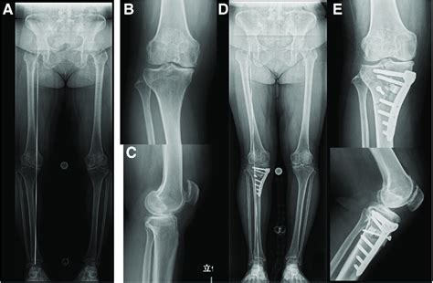 Preoperative And Postoperative Plane Radiographs Right Knee A