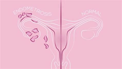 Myths About Endometriosis