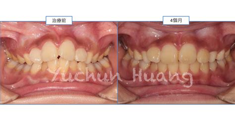 兒童及青少年牙齒隱形矯正專家 黃榆鈞醫師 2017