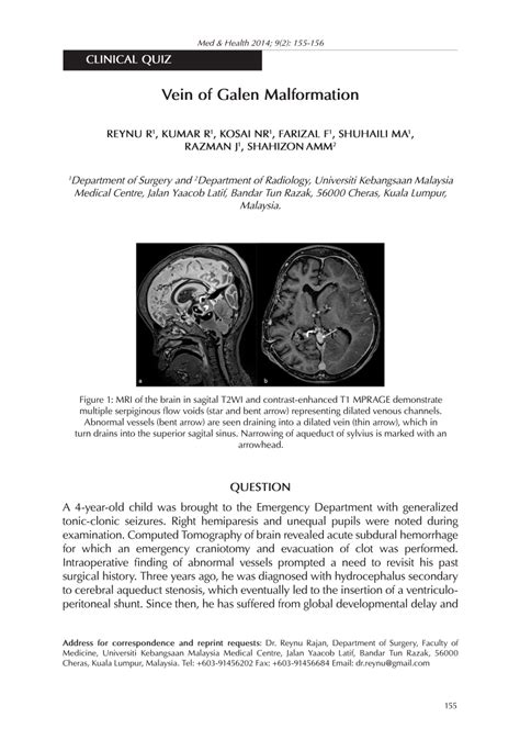 (PDF) Vein of Galen Malformation