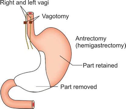 Vagotomy And Antrectomy