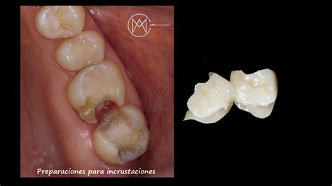 Incrustaciones Dentales Qu Son Y Para Qu Sirven