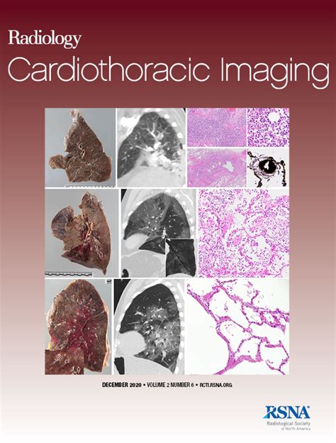 Role Of Coronary Ct Angiography In Spontaneous Coronary Artery