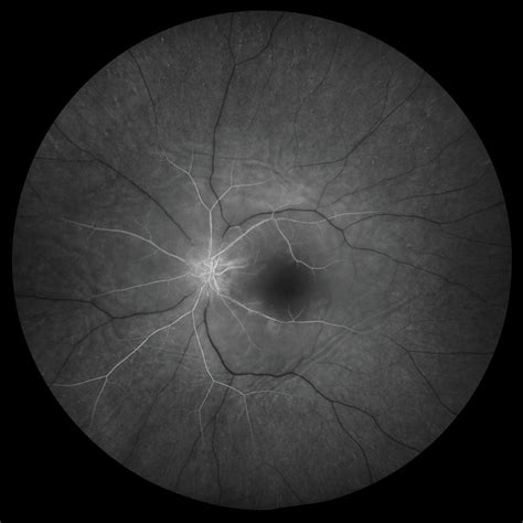 Central Retinal Artery Occlusion Os Crao