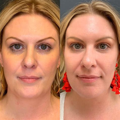 Transform Your Skin With Prp Explore Prp Before And After