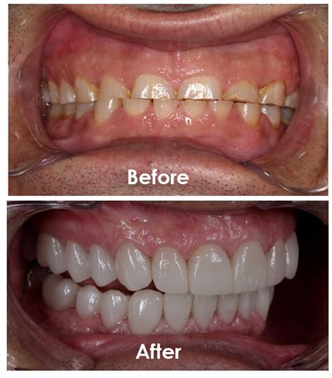 Full Mouth Restoration Tips 16 Top Tips For Your Perfect Smile