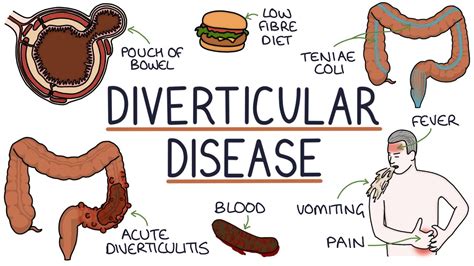 Diverticulitis Vs Diverticulosis