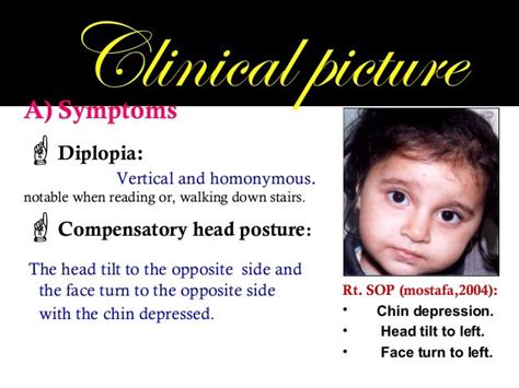 Superior Oblique Palsy