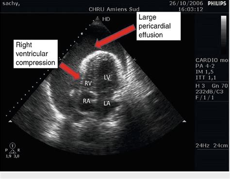 Figure 1 From Intraoperative Acute Cardiac Tamponade As A Result Of