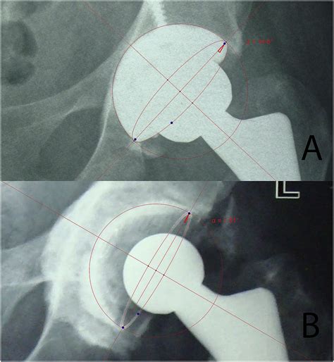 Geogebra A Reliable And Free Software For Measuring Acetabular Cup