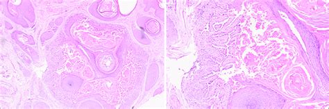 A Warty Dyskeratoma Endophytic Epidermal Proliferation With