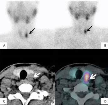 M Tc Sestamibi Mibi Scan And Spect Ct Images A Early