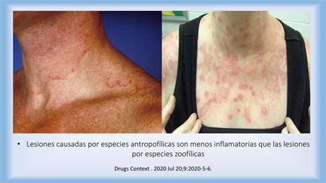 Dermatofitosis Tiñas Ppt