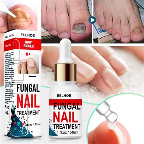 50ml Fungal Nail Repair Essences Serum Anti Infections Paronychia