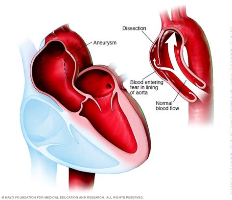 Symptoms and causes - Takayasu's arteritis - Mayo Clinic