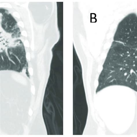 ct chest  admission showing significant multifocal airspace