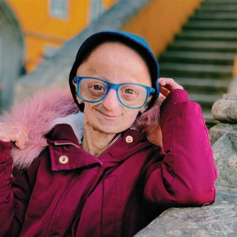 Woman With Progeria Ageing Seven Times Faster Than Normal Surpasses