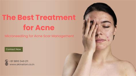 Microneedling For Acne Scar Management By Skination Clinic Issuu