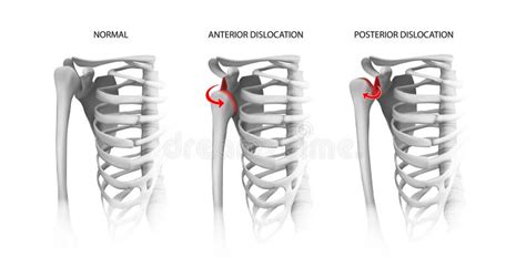 Shoulder Dislocation Options Stock Illustration Illustration Of