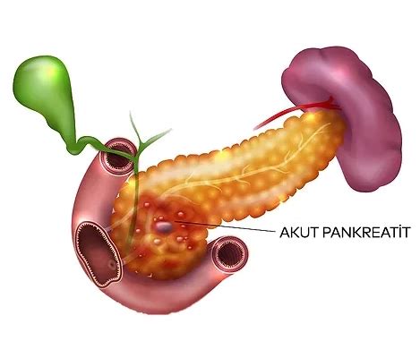 Akut Pankreatit Tedavisi Prof Dr Ali Ka An G Kakin