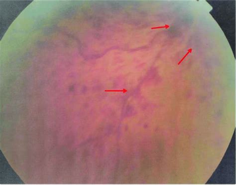 Superficial Flame Shaped Retinal Hemorrhages In Fundus Examination Download Scientific Diagram