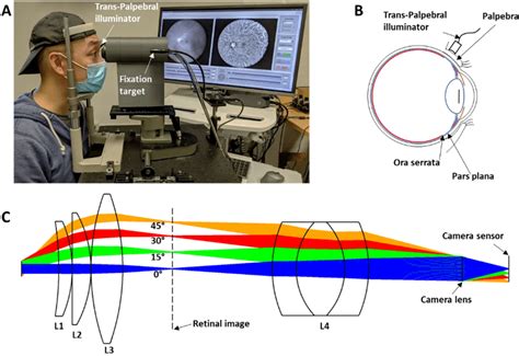 Nonmydriatic Wide Field Fundus Camera With Trans Palpebral Illuminator