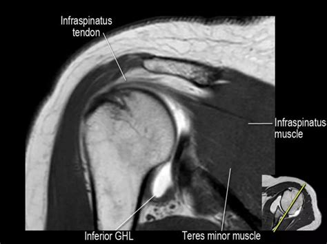 MRI of Shoulder anatomy | PPT