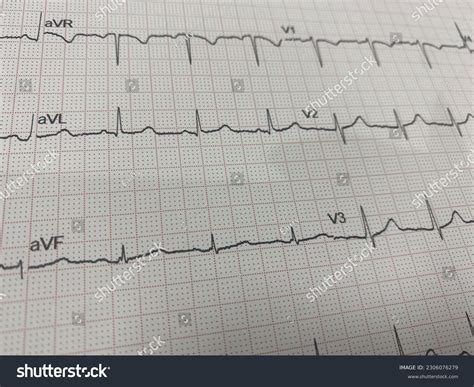 EKG Showing Normal Sinus Rhythm Royalty Free Stock Photo 2306076279