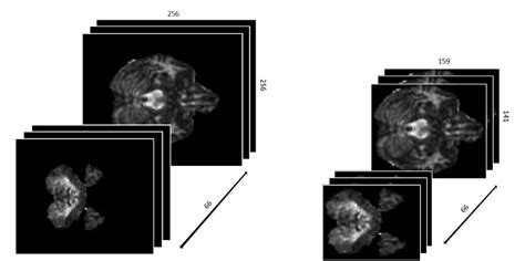 Figure 2 From Classification Of Subcortical Vascular Cognitive Impairment Using Single Mri