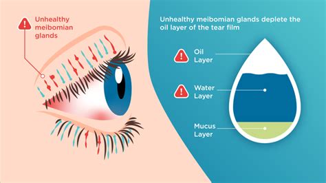 Tearcare® Goodman Eye Center