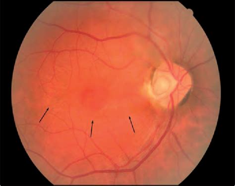 Figure 2 From Optic Disc Pit Maculopathy Treated With Vitrectomy Internal Limiting Membrane