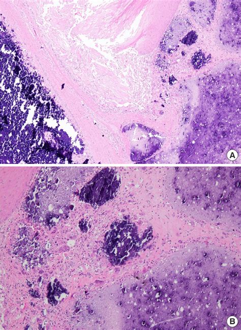 Figure 2 From A Rare Development Of Tumoral Calcinosis Of The Ear