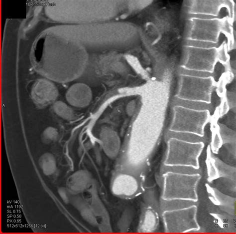 Superior Mesenteric Artery SMA Dissection As Spontaneous Event