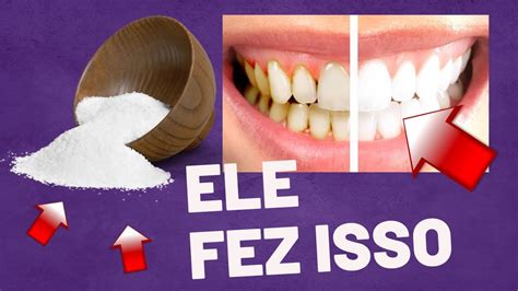 Como remover o tártaro do dente sem ajuda de um dentista Aprenda a