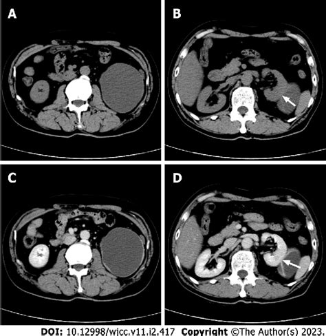 Figure 1 From Fat Poor Renal Angiomyolipoma With Prominent Cystic