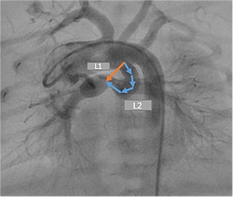 Frontiers Stenting Of High Tortuous Ducts In Duct Dependent Pulmonary