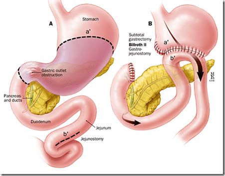 Gastrojejunostomy | Medicina, Saúde