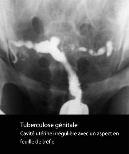 Tuberculose Génitale 2 Dr Kara Zaitri Ma