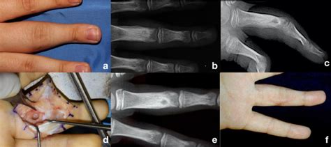 Figure From Osteoid Osteoma Of The Hand Surgical Treatment Versus Ct