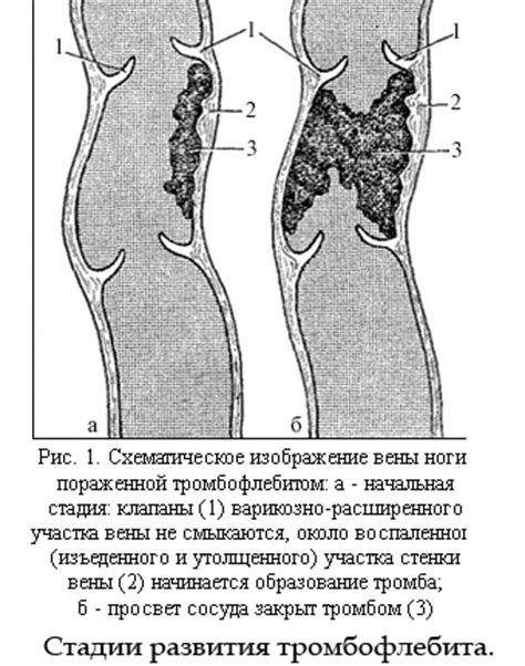 Закупорка вен на ногах, острый тромбофлебит? Самое эффективное лечение ...