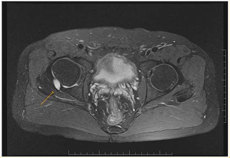 Acetabular Cyst With Femoro Acetabular Impingement Sumer S Radiology Blog